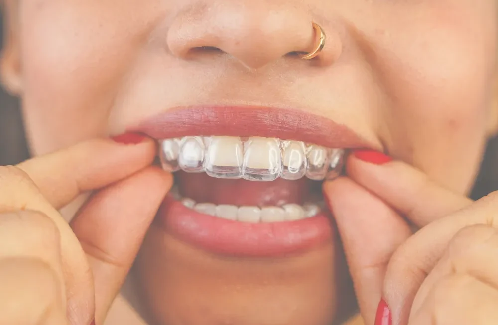 From clear aligners to Cfast cosmetic tooth alignment and fixed braces, Dental Expressions helps patients explore straighter smile options with professional guidance. || Your dentist can assess your teeth and explain which approach may suit your goals, lifestyle and dental needs.